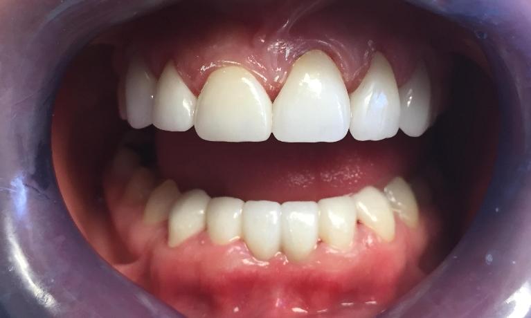 Zirconia-Crown-and-Bridge-Smile-Makeover-After-Image