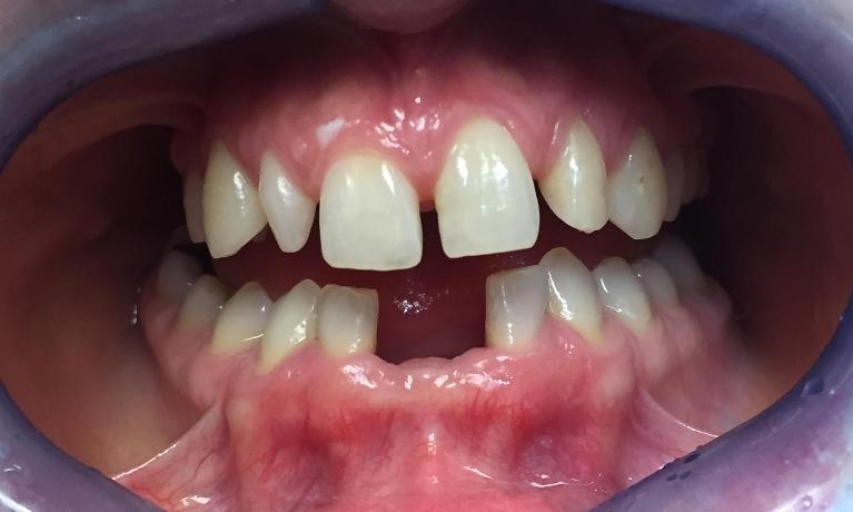 Zirconia-Crown-and-Bridge-Smile-Makeover-Before-Image